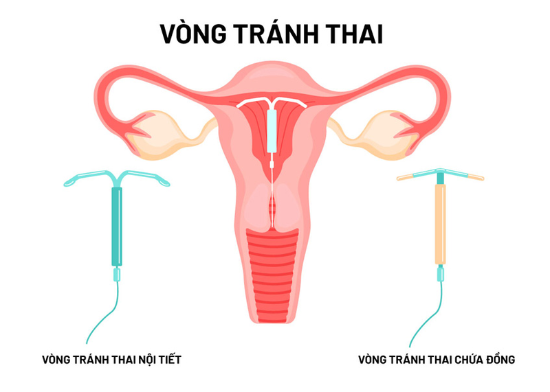 các biện pháp phòng tránh thai hiệu quả