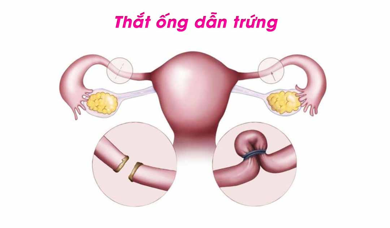 các biện pháp phòng tránh thai an toàn